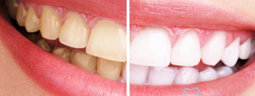 Blanqueamiento Dental Blog